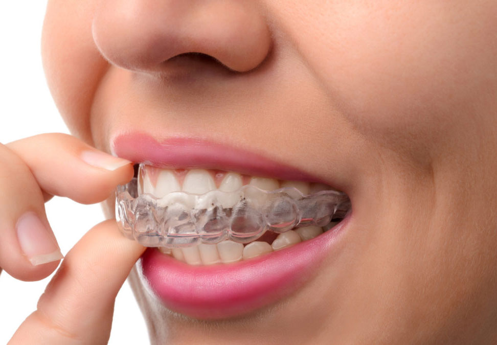 Dental Implants in Las Vegas - Discover Smiles Dental